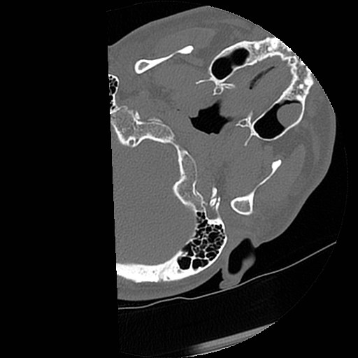 C1-C2 "subluxation" - normal cervical anatomy at maximum head rotation (Radiopaedia 42483-45607 Axial non-contrast 68).jpg