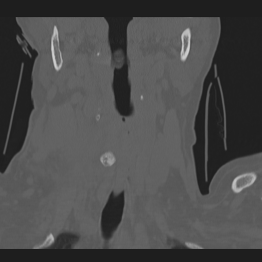 C2 fracture (Radiopaedia 34091-35341 Coronal bone window 8).png