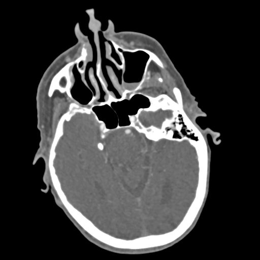 C2 fracture with vertebral artery dissection (Radiopaedia 37378-39200 A 222).png