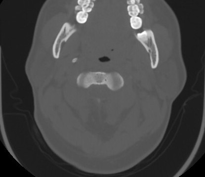 C7 laminar fracture and Klippel-Feil syndrome (Radiopaedia 86710-102850 Axial bone window 27).jpg