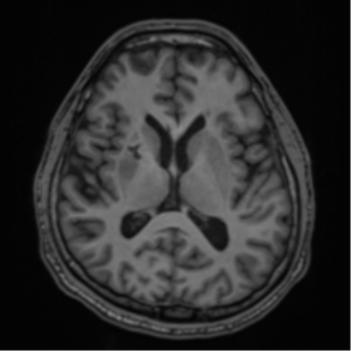 CNS vasculitis (Radiopaedia 55715-62263 Axial T1 35).png