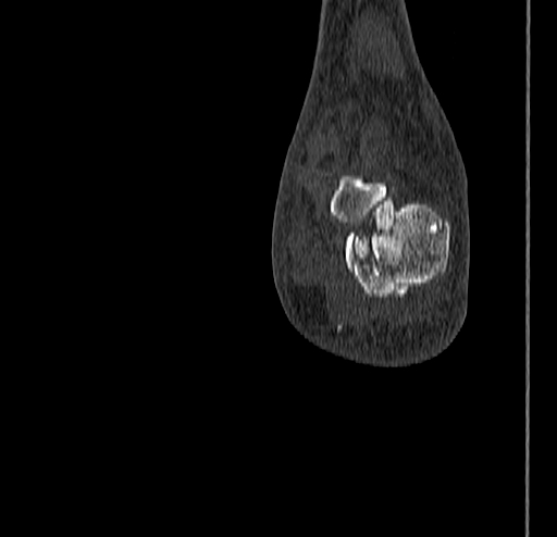 Calcaneal fracture - Sanders type 4 (Radiopaedia 90179-107370 Coronal bone window 78).jpg
