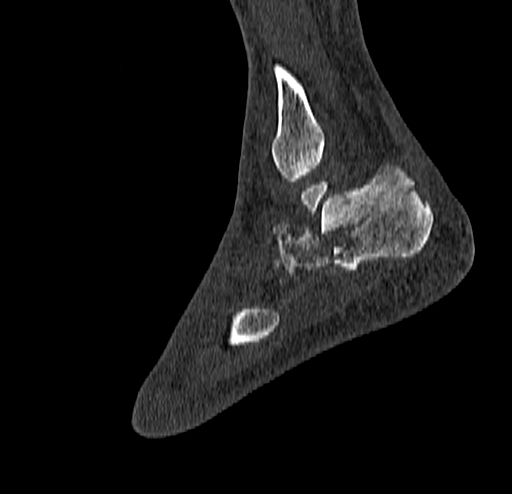 Calcaneal fracture - Sanders type 4 (Radiopaedia 90179-107370 Sagittal bone window 67).jpg