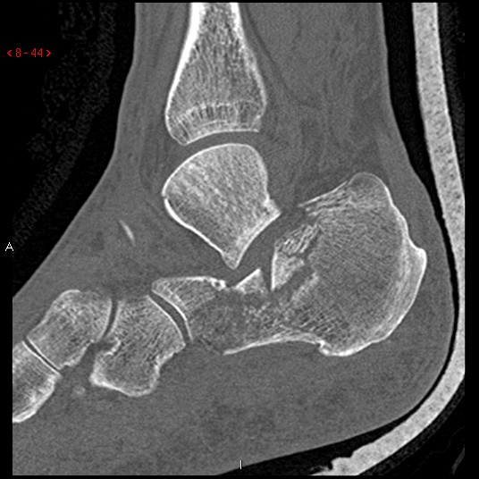 File:Calcaneal fracture and associated spinal injury (Radiopaedia 17896-17656 Sagittal bone window 4).jpg