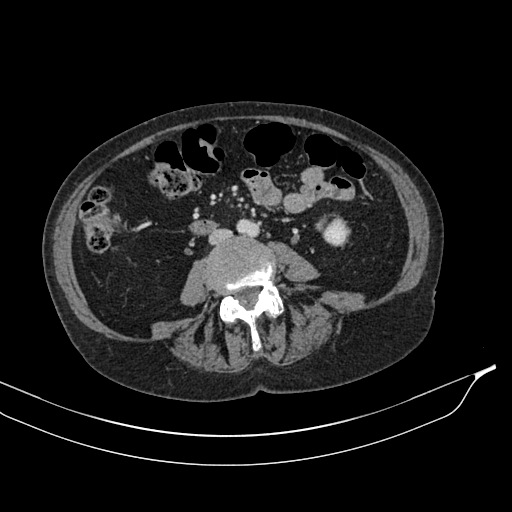 Calcified adrenal glands and Spigelian hernia (Radiopaedia 49741-54988 A 122).jpg