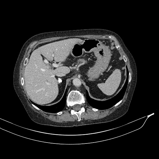 Calcified adrenal glands and Spigelian hernia (Radiopaedia 49741-54988 A 49).jpg