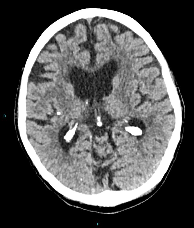 Calcified cerebral emboli from left ventricular thrombus (Radiopaedia 84420-99758 Axial non-contrast 47).jpg