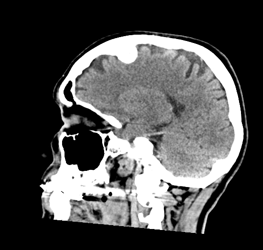 File:Calcified meningioma (Radiopaedia 74361-85243 D 9).jpg