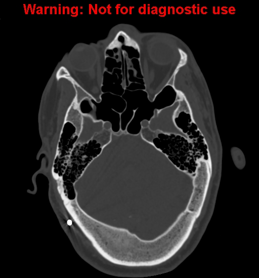 Calvarial thickening from chronic shunting (Radiopaedia 60079-67637 Axial bone window 52).jpg
