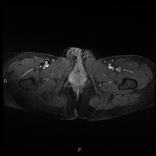 File:Canal of Nuck cyst (Radiopaedia 55074-61448 Axial T1 C+ fat sat 58).jpg