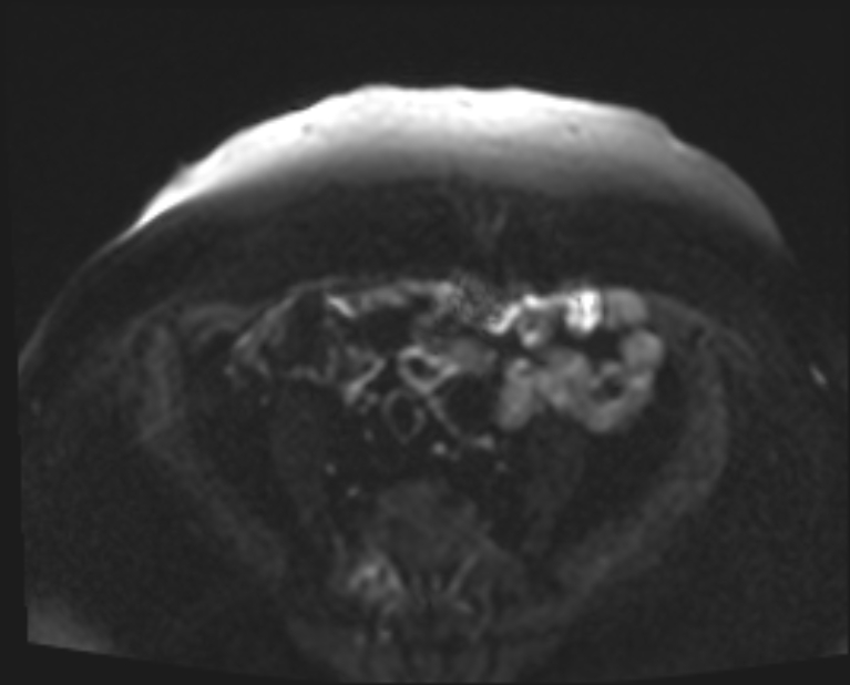 Cancer cervix - stage IIb (Radiopaedia 75411-86615 Axial DWI 29).jpg