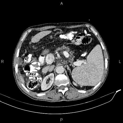 Caput medusae sign - portal hypertension (Radiopaedia 64007-72759 A 24).jpg