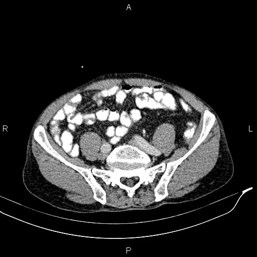 Caput medusae sign - portal hypertension (Radiopaedia 64007-72759 A 71).jpg