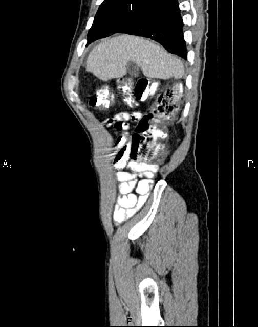 Caput medusae sign - portal hypertension (Radiopaedia 64007-72759 B 5).jpg