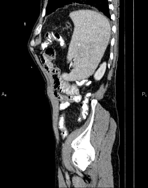 Caput medusae sign - portal hypertension (Radiopaedia 64007-72759 B 72).jpg