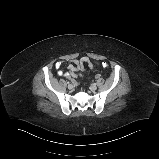 File:Carcinoid tumor - terminal ileum (Radiopaedia 60931-68739 A 101).jpg