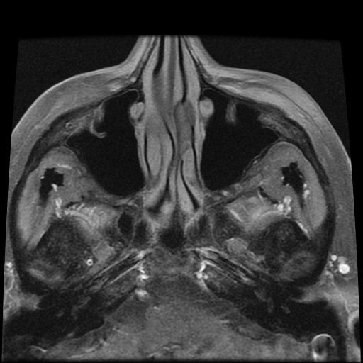 File:Carcinoid tumor of the ileum with metastasis to orbit (Radiopaedia 28165-28424 Axial T1 C+ fat sat 3).jpg