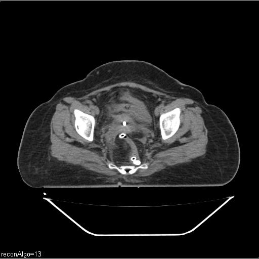 Carcinoma cervix- brachytherapy applicator (Radiopaedia 33135-34173 Axial non-contrast 28).jpg