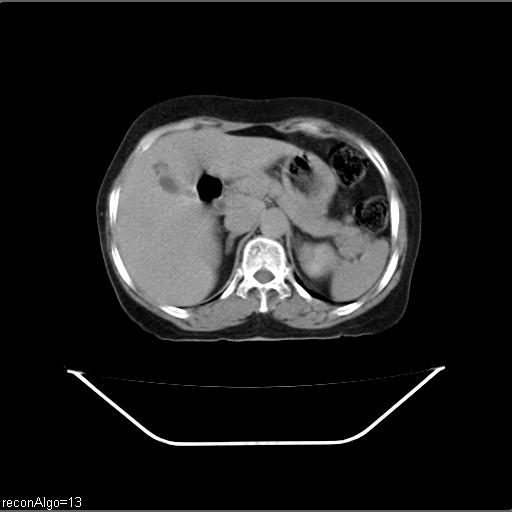 File:Carcinoma cervix- recurrence (Radiopaedia 34702-36137 Axial C+ delayed 2).jpg