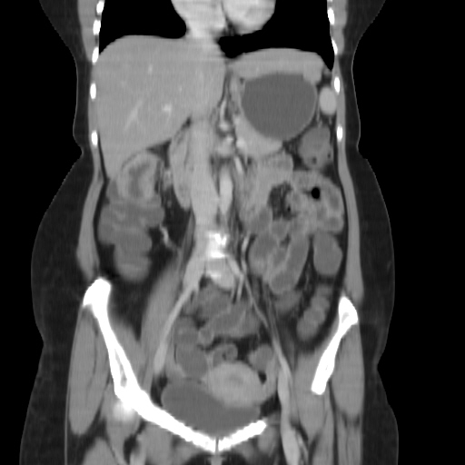 File:Carcinoma colon - hepatic flexure (Radiopaedia 19461-19493 B 19).jpg