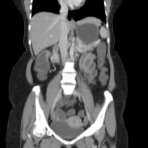 File:Carcinoma colon - hepatic flexure (Radiopaedia 19461-19493 B 21).jpg