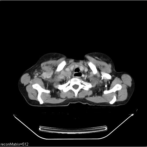 File:Carcinoma of esophagus (Radiopaedia 27356-27550 A 30).jpg