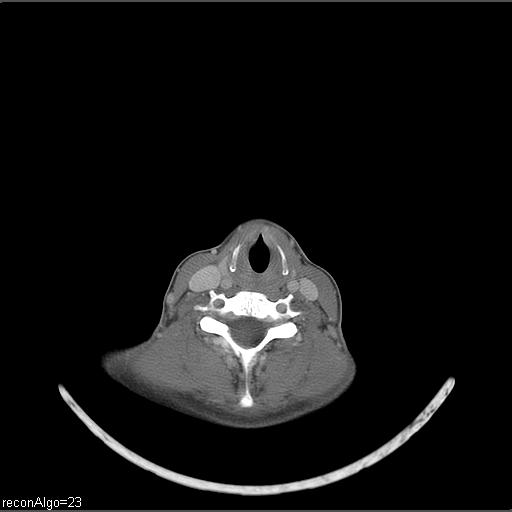 File:Carcinoma of the maxillary antrum (Radiopaedia 53805-59888 Axial C+ delayed 15).jpg