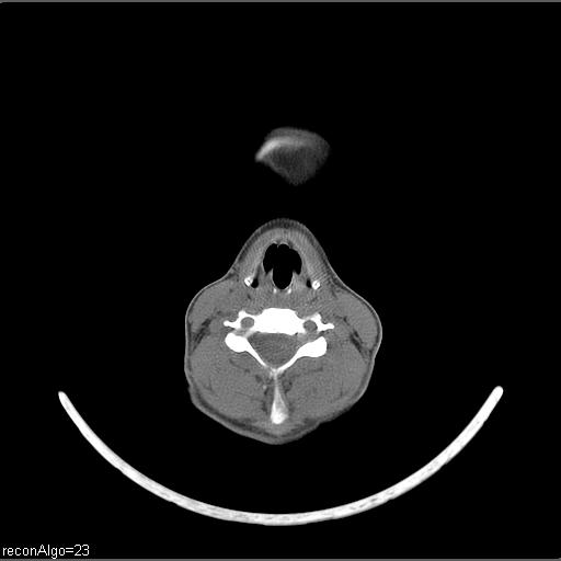 Carcinoma of the maxillary antrum (Radiopaedia 53805-59888 Axial non-contrast 27).jpg