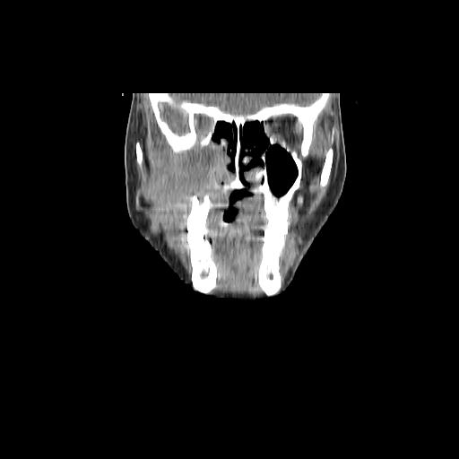 Carcinoma of the maxillary antrum (Radiopaedia 53805-59888 Coronal C+ delayed 42).jpg