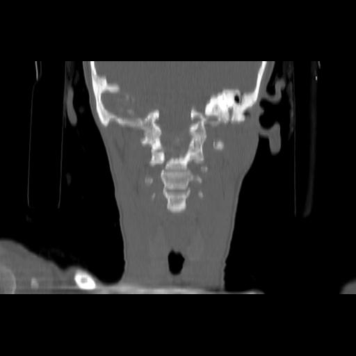 Carcinoma of the maxillary antrum (Radiopaedia 53805-59888 Coronal bone window 99).jpg