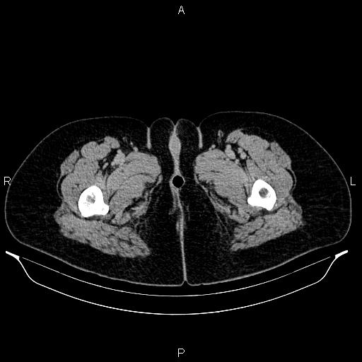File:Carcinoma of uterine cervix (Radiopaedia 85861-101700 Axial C+ delayed 103).jpg