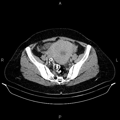 File:Carcinoma of uterine cervix (Radiopaedia 85861-101700 Axial C+ delayed 70).jpg