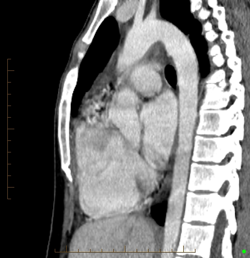 Cardiac paraganglioma (Radiopaedia 76345-88005 C 53).jpg