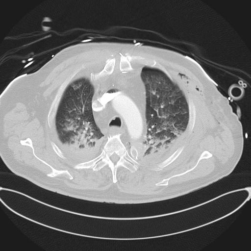Cardiac trauma (Radiopaedia 32874-33858 Axial lung window 15).jpg