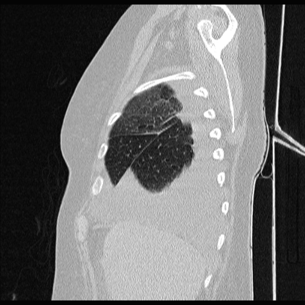 Cardiogenic pulmonary edema (Radiopaedia 29213-29609 Sagittal lung window 16).jpg