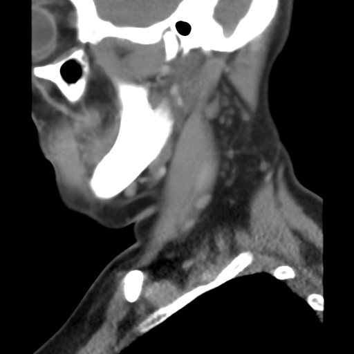 File:Carotid body tumor (paraganglioma) (Radiopaedia 38586-40729 C 9).jpg