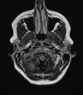 File:Cavernoma with bleed - midbrain (Radiopaedia 54546-60774 Axial FLAIR 4).png