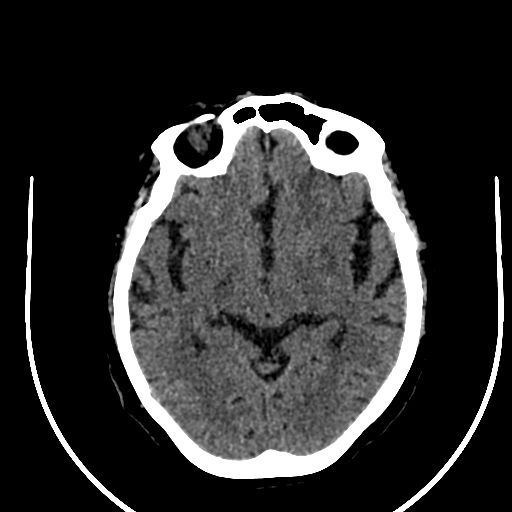 Cavernous hemangioma of the cerebellar falx (Radiopaedia 73025-83723 Axial non-contrast 61).jpg