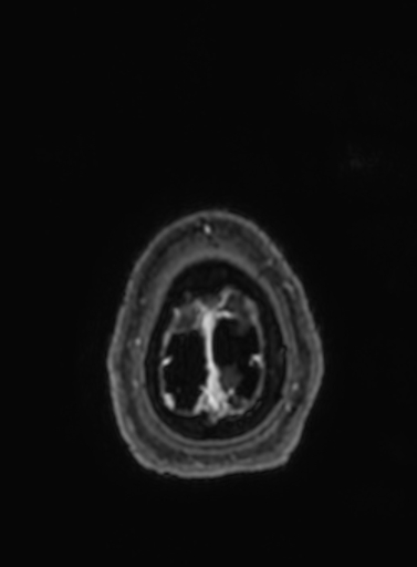Cavernous hemangioma of the cerebellar falx (Radiopaedia 73025-83724 Axial T1 C+ 20).jpg