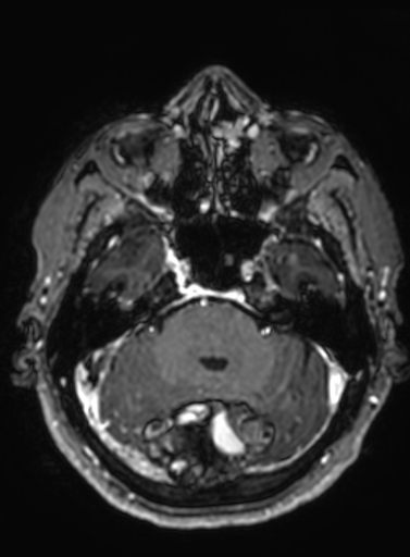 Cavernous hemangioma of the cerebellar falx (Radiopaedia 73025-83724 Axial T1 C+ 244).jpg