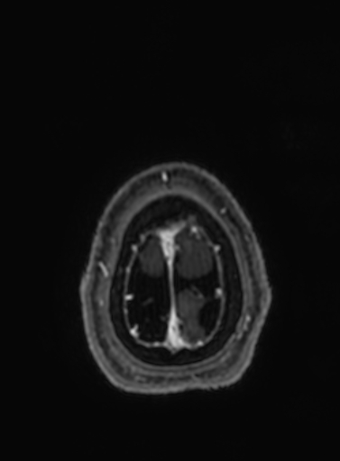 Cavernous hemangioma of the cerebellar falx (Radiopaedia 73025-83724 Axial T1 C+ 26).jpg