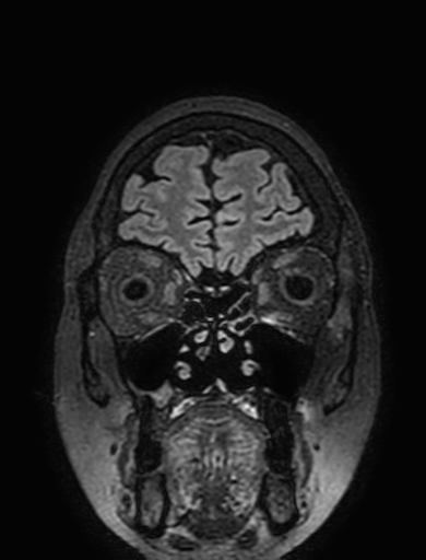 Cavernous hemangioma of the cerebellar falx (Radiopaedia 73025-83724 Coronal FLAIR 46).jpg