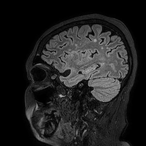 File:Cavernous hemangioma of the cerebellar falx (Radiopaedia 73025-83724 Sagittal FLAIR 51).jpg