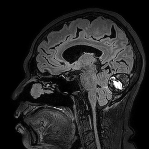 Cavernous hemangioma of the cerebellar falx (Radiopaedia 73025-83724 Sagittal FLAIR 96).jpg