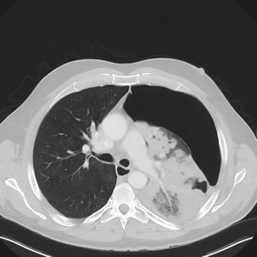 File:Cavitating pneumonia complicated by pneumothorax (Radiopaedia 48149-52994 Axial lung window 28).png