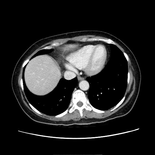 Cecal adenocarcinoma (Radiopaedia 75909-87331 A 15).jpg