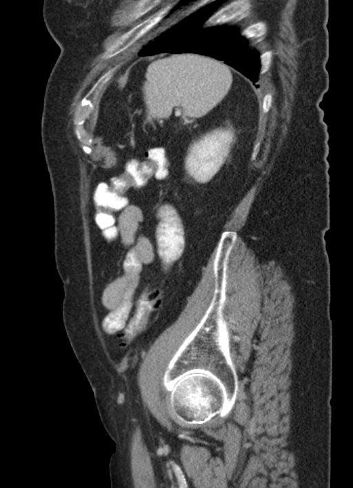 Cecal adenocarcinoma - surgical scar recurrence (Radiopaedia 79988-93264 D 15).jpg