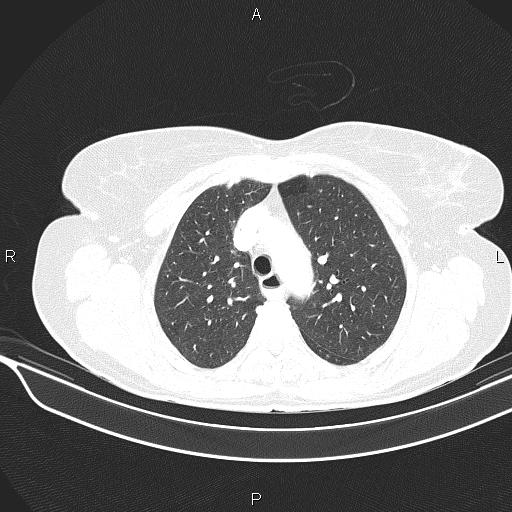 Cecal cancer (Radiopaedia 85610-101358 Axial lung window 19).jpg
