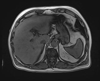 Cecal mass causing appendicitis (Radiopaedia 59207-66532 D 33).jpg