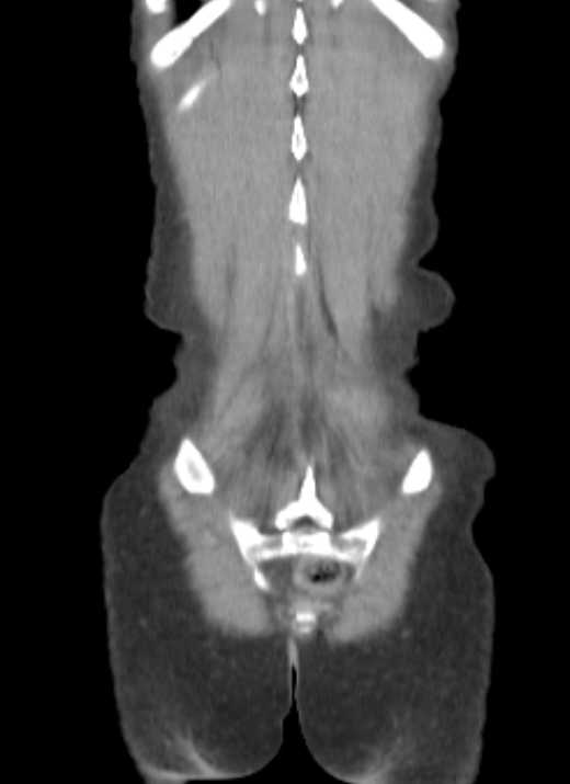 Cecal volvulus with pneumatosis coli (Radiopaedia 68572-78178 B 4).jpg